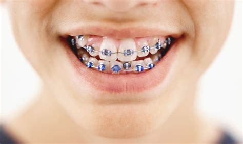 why would someone need braces